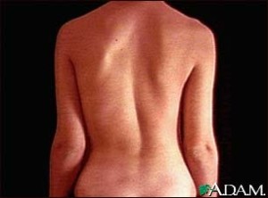 scoliosis-1